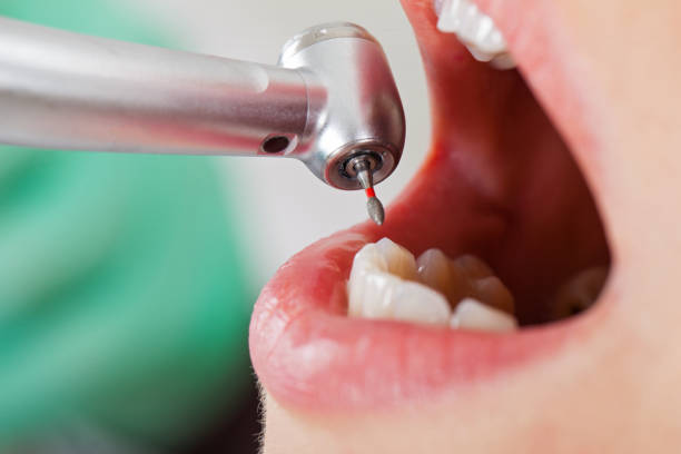 Best Emergency Dental Care for Broken or Chipped Teeth in North Hudson, WI